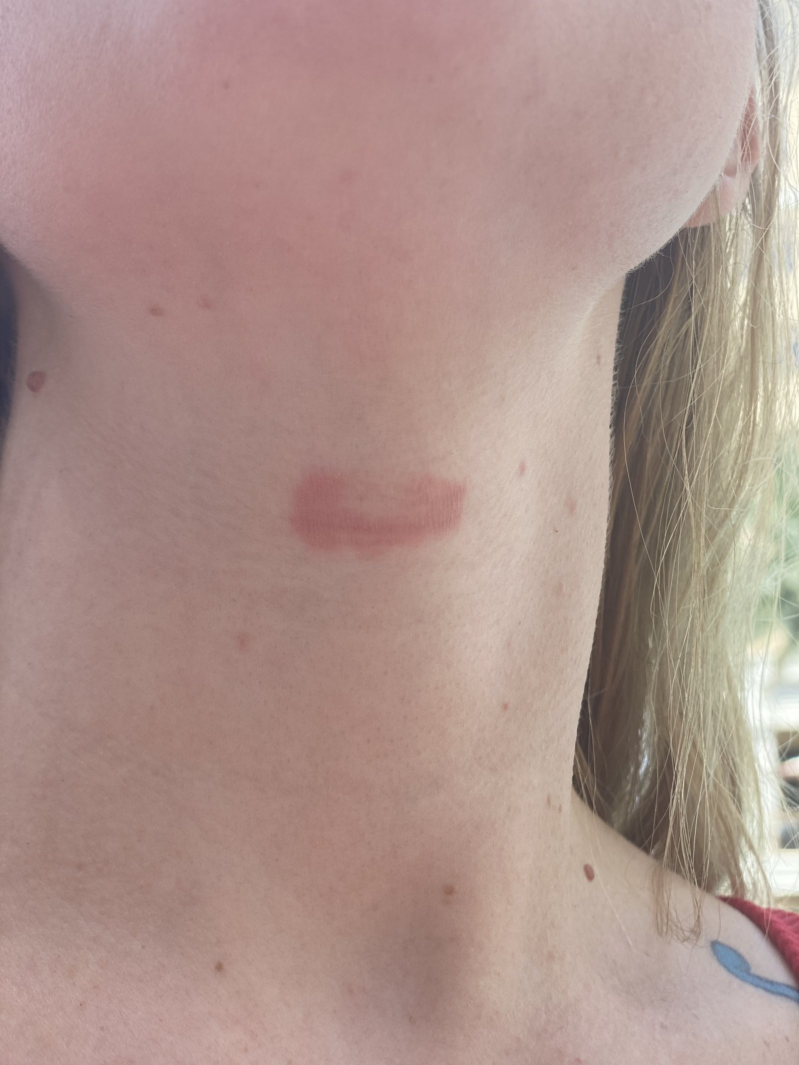 Early 2022, the original dime-sized spot on Larae's throat before topical steroid withdrawal — The Bronze Lily, St. Petersburg, FL